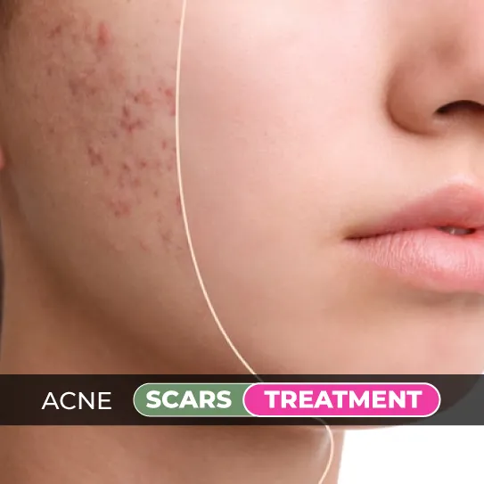 acne scars treatment