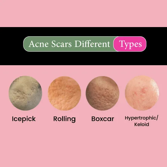 acne scars types