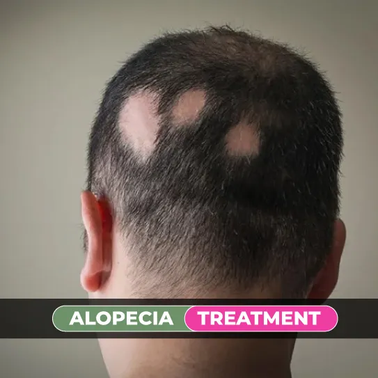 alopecia treatment