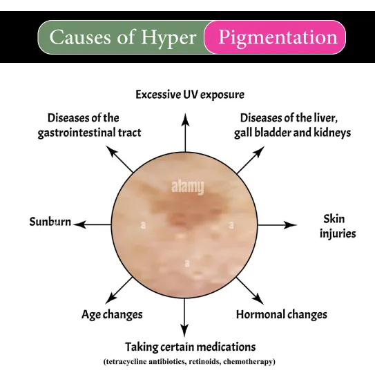 causes of hyperpigmentation