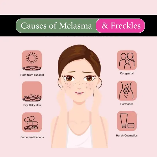 causes of melasma freckles