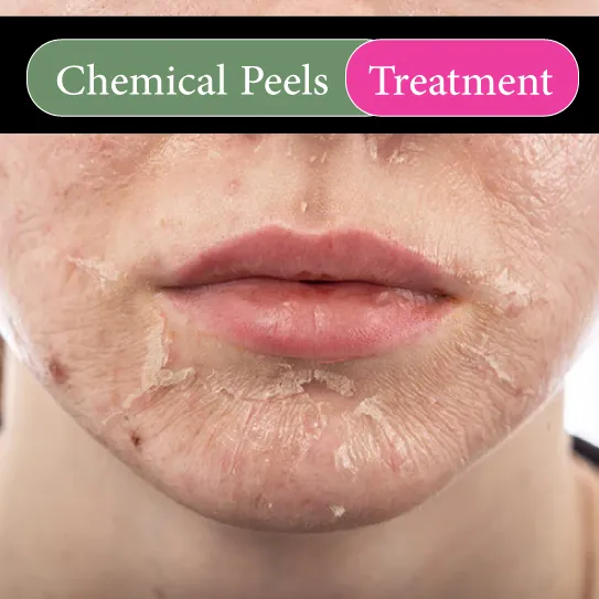 chemical peels treatment