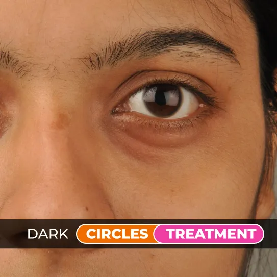 dark circle treatment