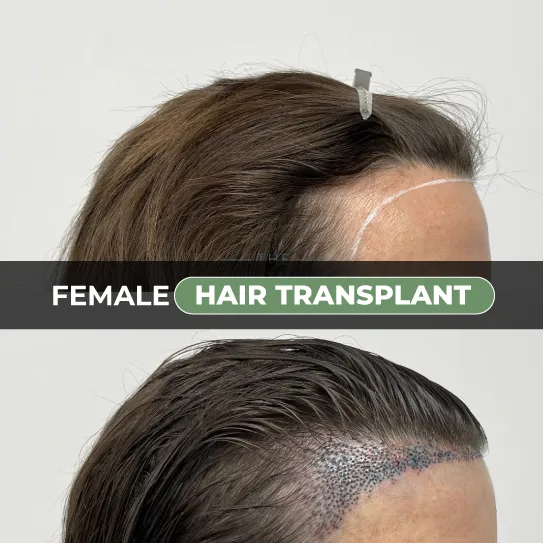 female hair transplant