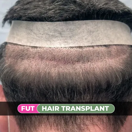 fue hair transplant