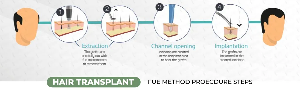 hair transplant steps