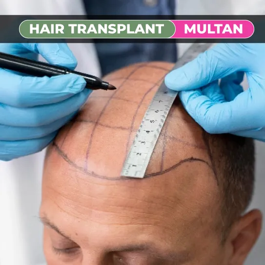 hair transplant in multan