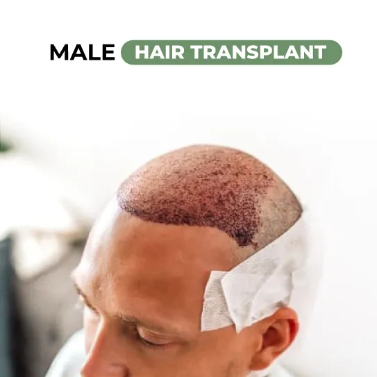 male hair transplant