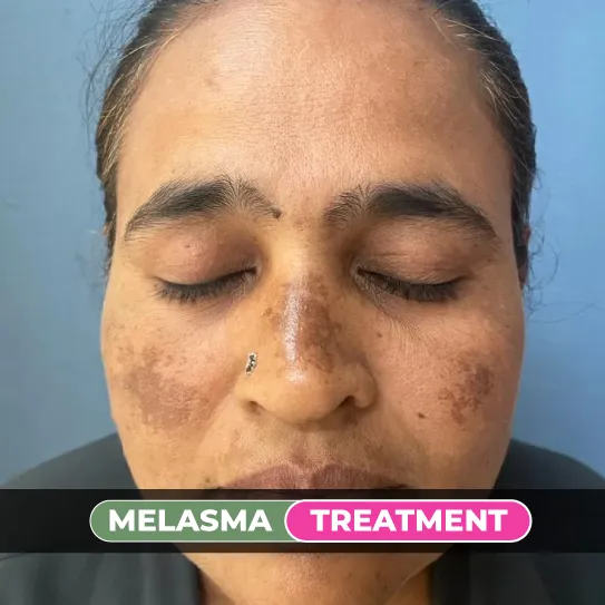 Melasma & Freckles Treatment