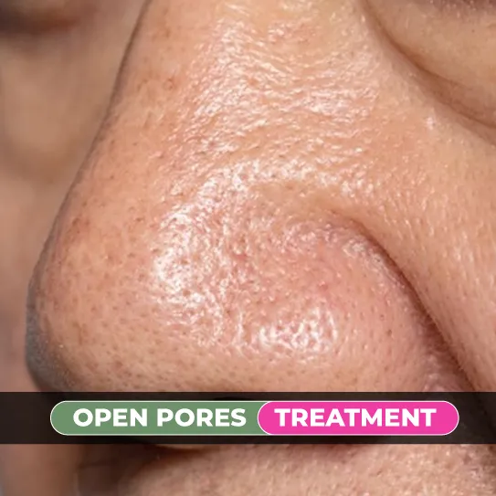 open pores treatment