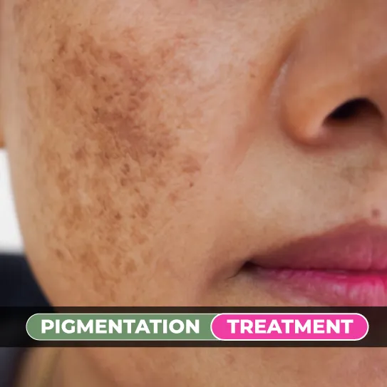 hyperpigmentation treatment