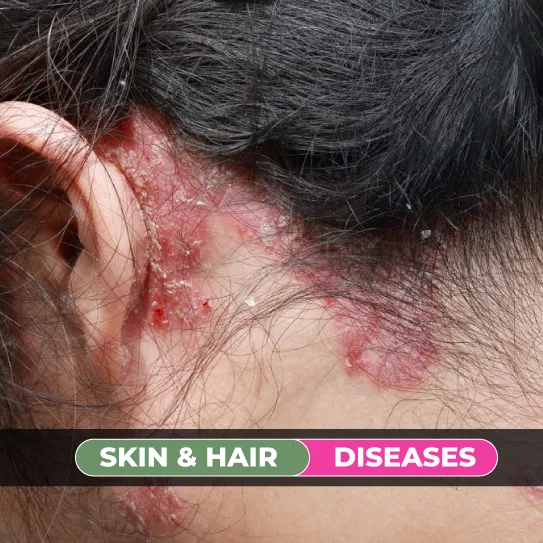 skin and hair diseases