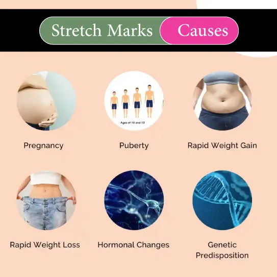 stretch marks causes