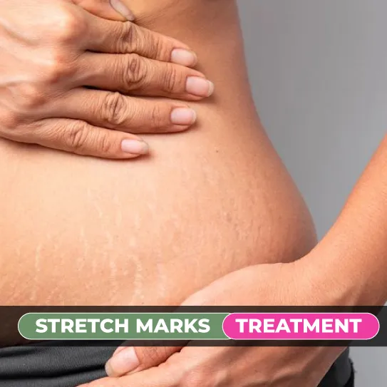 stretch marks treatment