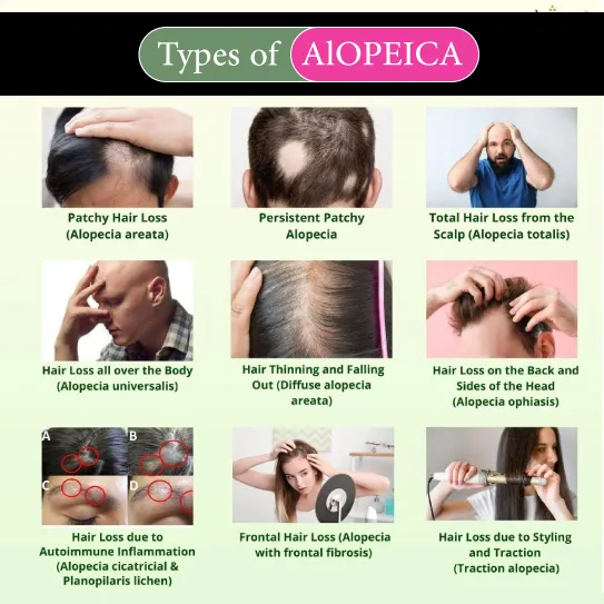 types of alopecia